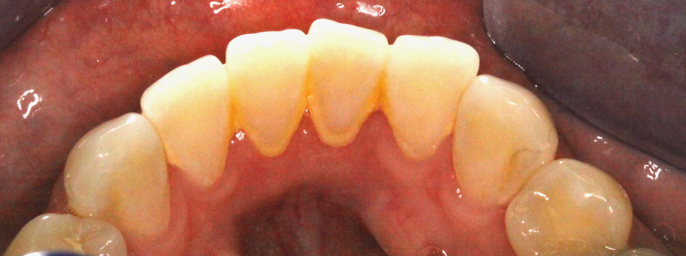 before photo bonding