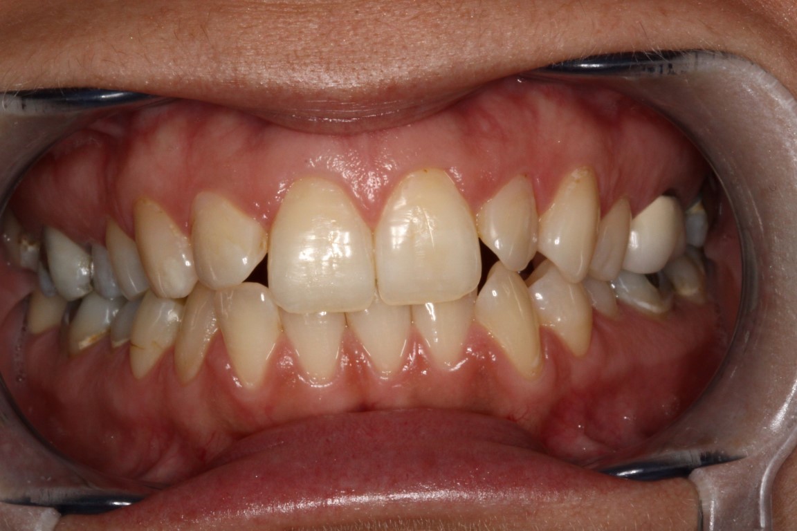 composite veneers before