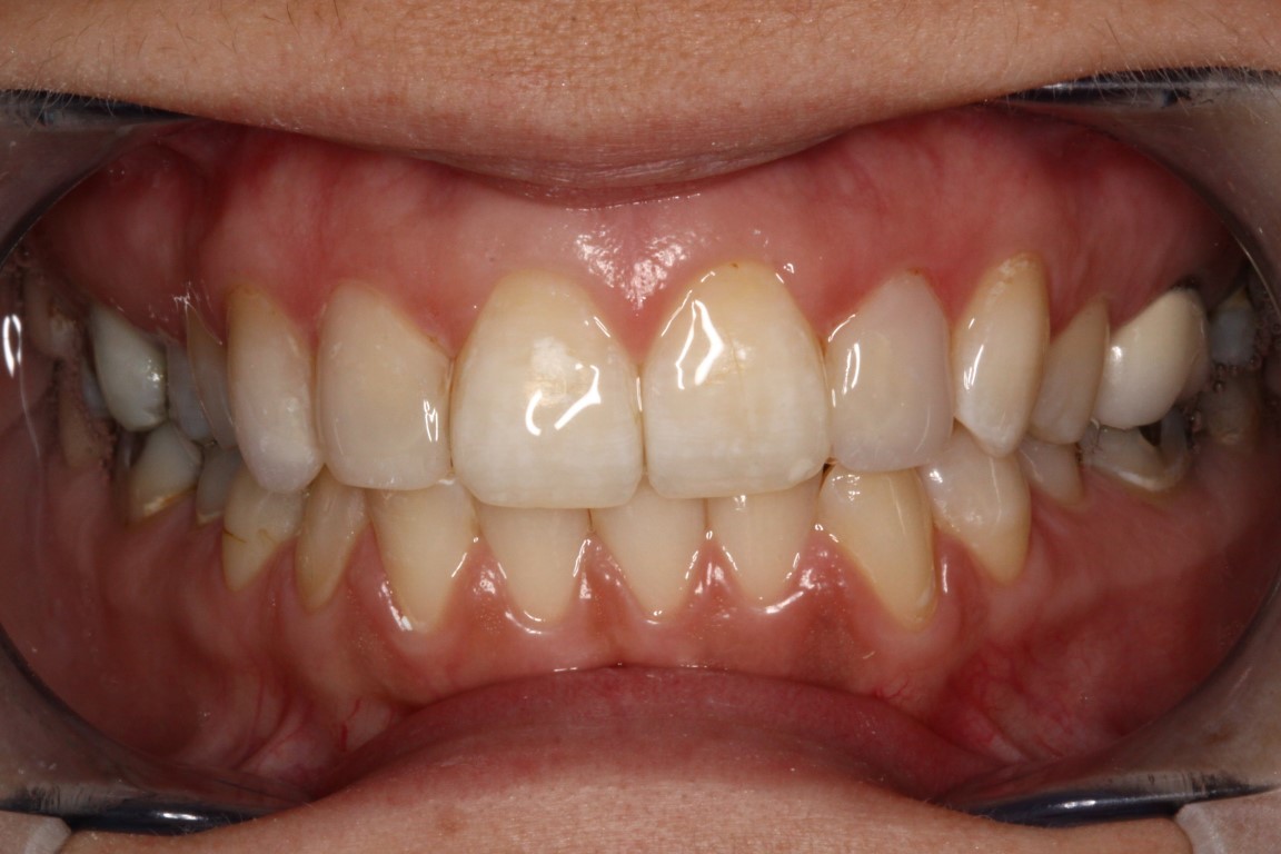 composite veneers after