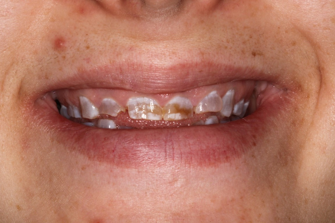 full mouth recon before