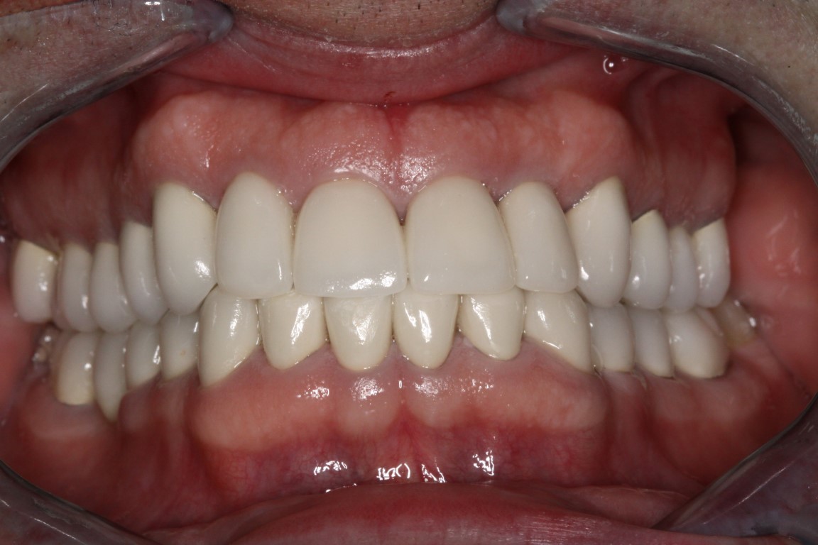 full mouth recon post