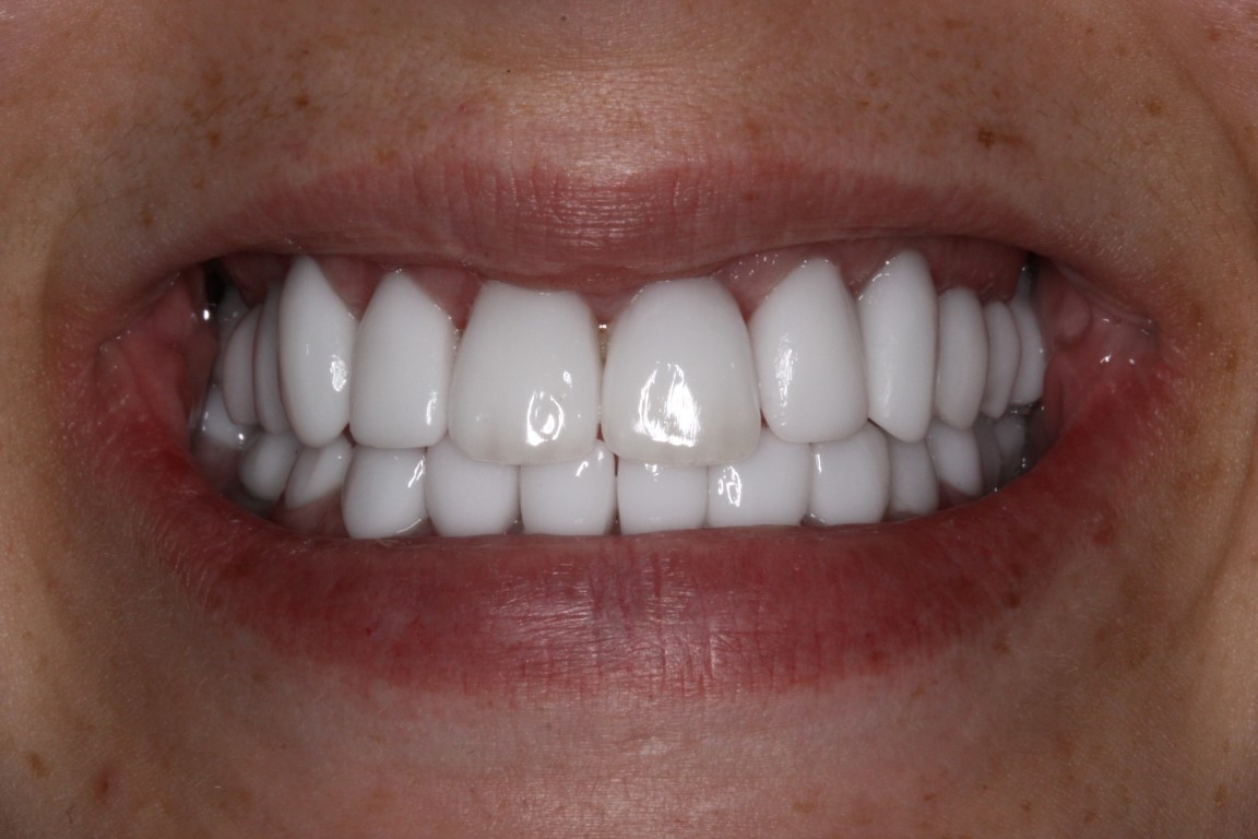 full mouth recon after