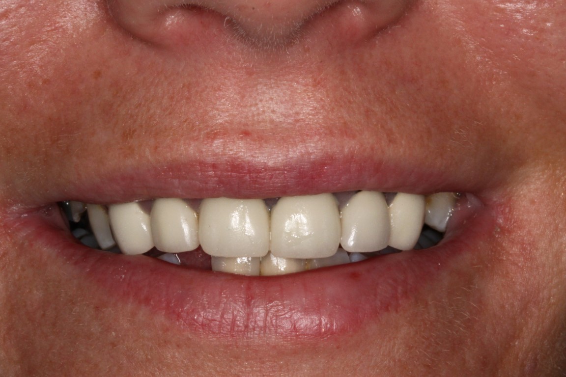porcelain veneers before