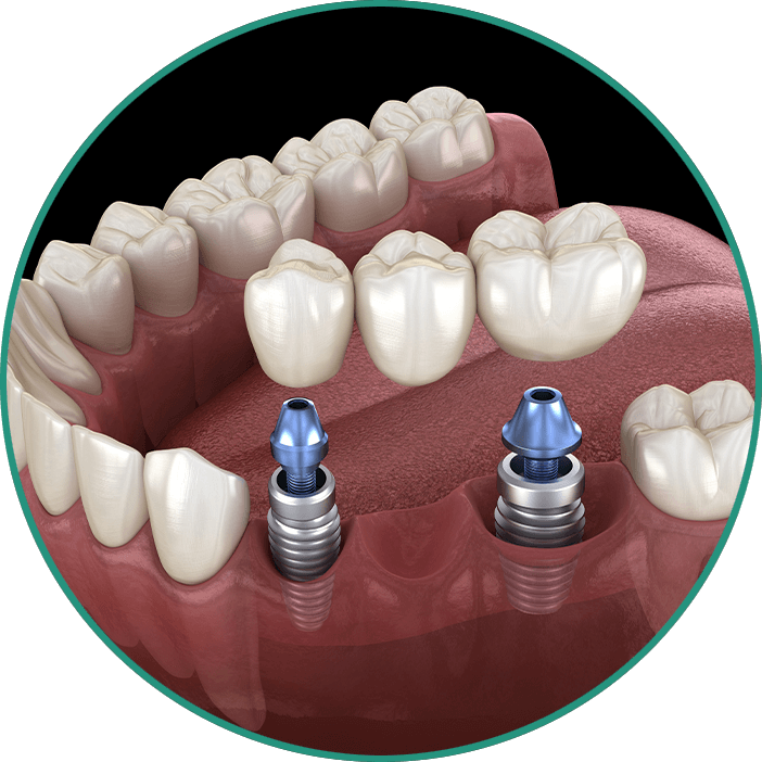 dental bridge 3d