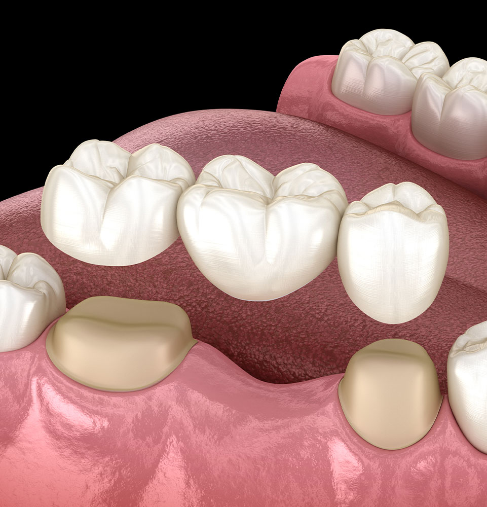 dental bridge 3d model