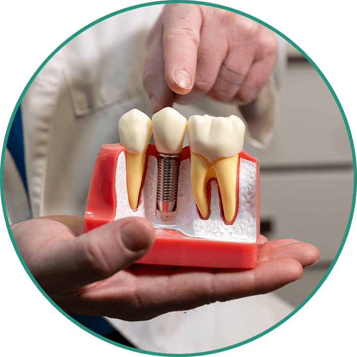 dental implant model burke