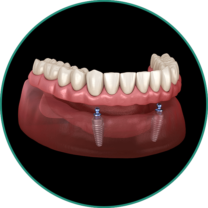 denture 3d