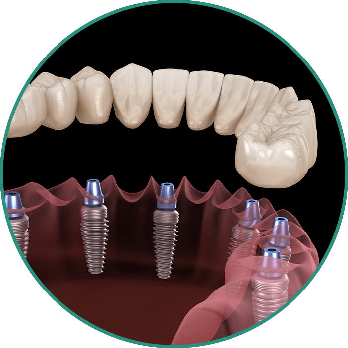 full arch 3d