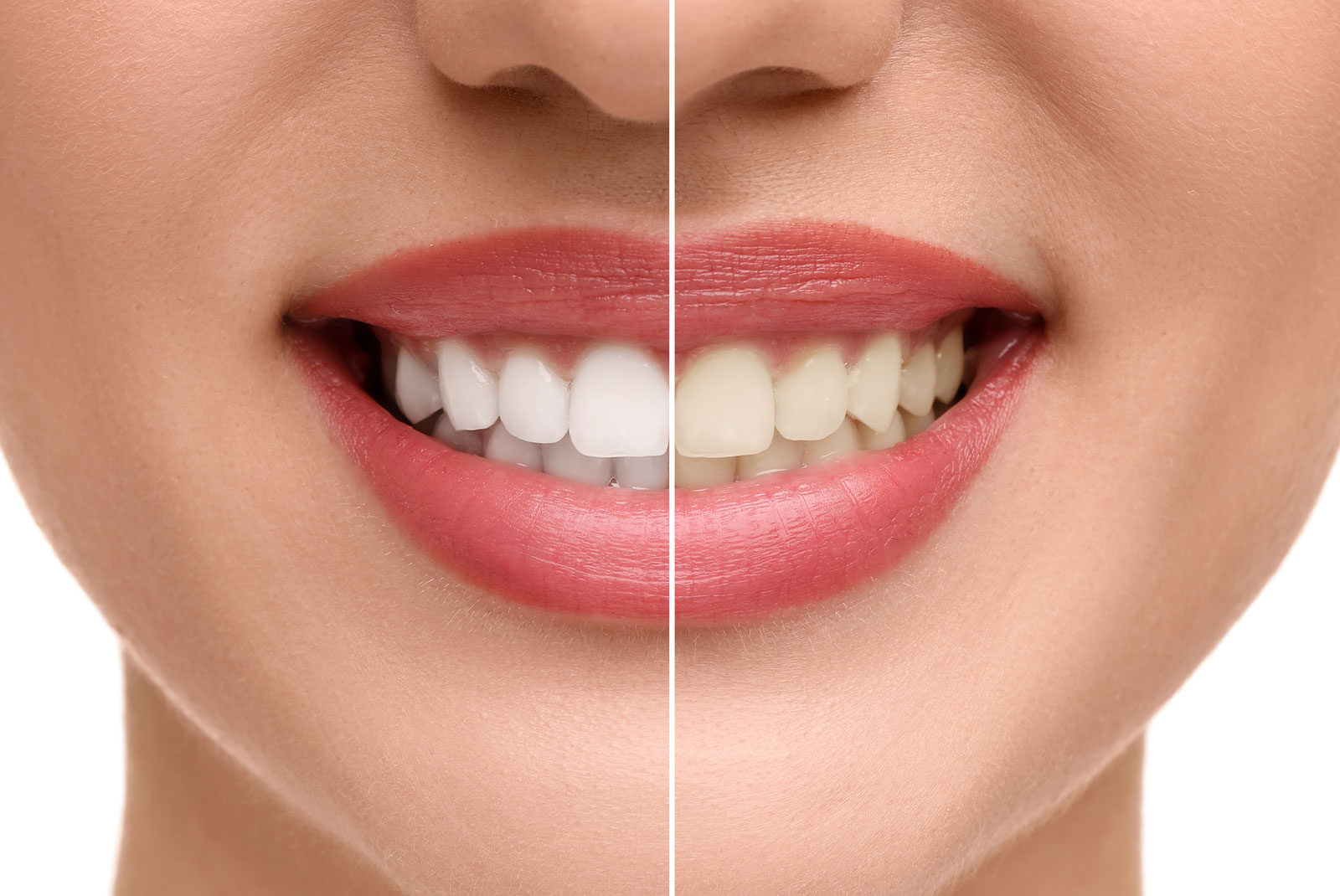 teeth whitening ba stock